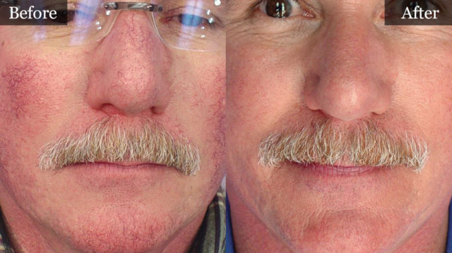 Vascular Treatment Before and After
