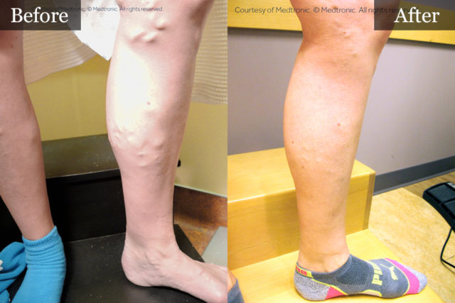 Vein Treatments Before and After