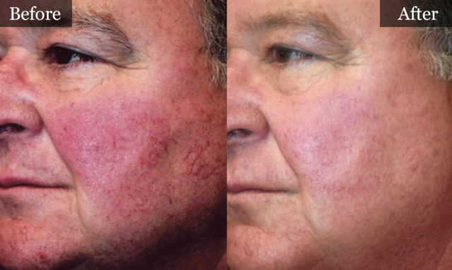 Vascular Treatment Before and After