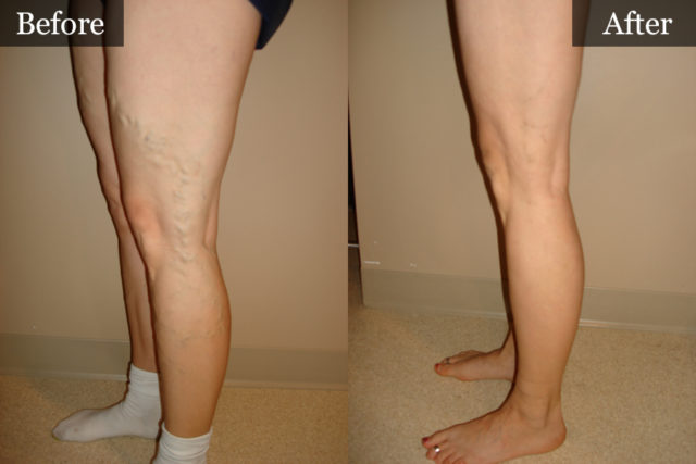 Vein Treatments Before and After