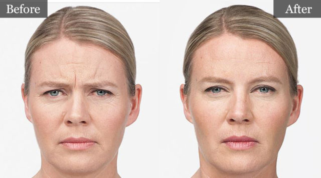 BOTOX Before and After