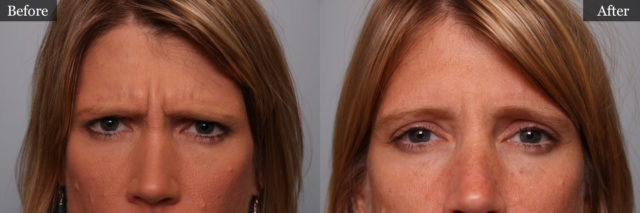 BOTOX Before and After